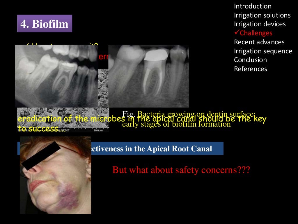 Irrigation in endodontics