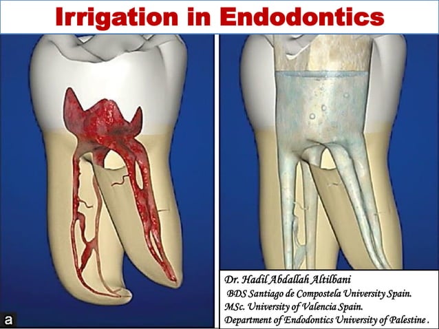 Irrigation in Endodontics.pdf | Dental Health | Diseases and Conditions
