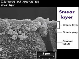 Softening and removing the
smear layer
 