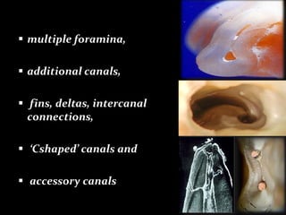 7
 multiple foramina,
 additional canals,
 fins, deltas, intercanal
connections,
 ‘Cshaped’ canals and
 accessory canals
 