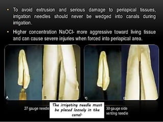 81
The irrigating needle must
be placed loosely in the
canal.
 