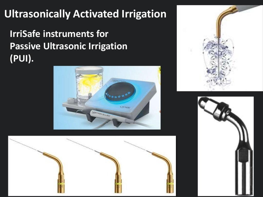 Endodontic Irrigation and root canal medicament the new methods of…