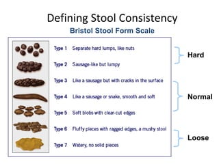 Defining Stool Consistency
Bristol Stool Form Scale
Hard
Normal
Loose
 