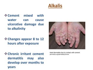Alkalis
Cement mixed with
water can cause
ulcerative damage due
to alkalinity
Changes appear 8 to 12
hours after exposure
Chronic irritant cement
dermatitis may also
develop over months to
years
Hand dermatitis due to contact with cement
dermnetnz.org/dermatitis/chrome
 