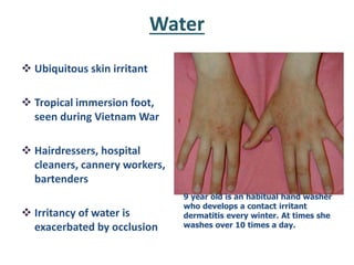 Water
 Ubiquitous skin irritant
 Tropical immersion foot,
seen during Vietnam War
 Hairdressers, hospital
cleaners, cannery workers,
bartenders
 Irritancy of water is
exacerbated by occlusion
9 year old is an habitual hand washer
who develops a contact irritant
dermatitis every winter. At times she
washes over 10 times a day.
 
