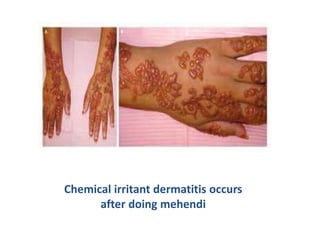 Chemical irritant dermatitis occurs
after doing mehendi
 