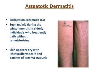 Asteatotic Dermatitis
• Exsiccation eczematid ICD
• Seen mainly during the
winter months in elderly
individuals who frequently
bath without
remoisturizing
• Skin appears dry with
ichthyosiform scale and
patches of eczema craquele
 