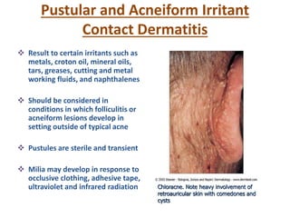 Pustular and Acneiform Irritant
Contact Dermatitis
 Result to certain irritants such as
metals, croton oil, mineral oils,
tars, greases, cutting and metal
working fluids, and naphthalenes
 Should be considered in
conditions in which folliculitis or
acneiform lesions develop in
setting outside of typical acne
 Pustules are sterile and transient
 Milia may develop in response to
occlusive clothing, adhesive tape,
ultraviolet and infrared radiation Chloracne. Note heavy involvement of
retroauricular skin with comedones and
cysts
 