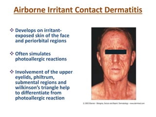 Airborne Irritant Contact Dermatitis
 Develops on irritant-
exposed skin of the face
and periorbital regions
 Often simulates
photoallergic reactions
 Involvement of the upper
eyelids, philtrum,
submental regions and
wilkinson’s triangle help
to differentiate from
photoallergic reaction
 
