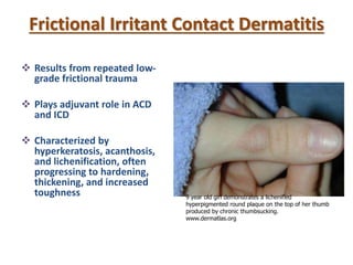 Frictional Irritant Contact Dermatitis
 Results from repeated low-
grade frictional trauma
 Plays adjuvant role in ACD
and ICD
 Characterized by
hyperkeratosis, acanthosis,
and lichenification, often
progressing to hardening,
thickening, and increased
toughness 9 year old girl demonstrates a lichenified
hyperpigmented round plaque on the top of her thumb
produced by chronic thumbsucking.
www.dermatlas.org
 