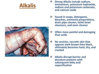 Alkalis
 Strong Alkalis include sodium,
ammonium, potassium hydroxide,
sodium and potassium carbonate,
and calcium oxide
 Found in soaps, detergents,
bleaches, ammonia preparations,
drain pipe cleaner, toilet bowl
cleansers, and oven cleaner
 Often more painful and damaging
than acids
 No vesicles, necrotic skin that
appears dark brown then black,
ultimately becomes hard, dry, and
cracked
 Alkalis disrupt barrier and
denature proteins with
subsequent fatty acid
saponification
 
