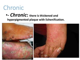 Chronic
•- Chronic: there is thickened and
hyperpigmented plaque with lichenification.
 
