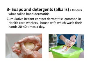 3- Soaps and detergents (alkalis) : causes
what called hand dermatitis
Cumulative irritant contact dermatitis: common in
Health care workers , house wife which wash their
hands 20-40 times a day.
 