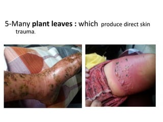 5-Many plant leaves : which produce direct skin
trauma.
 