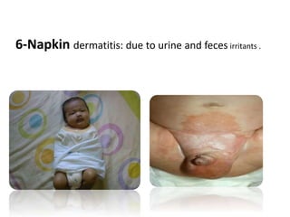 6-Napkin dermatitis: due to urine and feces irritants .
 