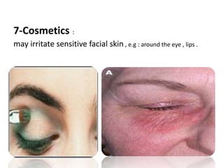 7-Cosmetics :
may irritate sensitive facial skin , e.g : around the eye , lips .
 