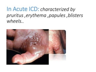 In Acute ICD: characterized by
pruritus ,erythema ,papules ,blisters
wheels..
 
