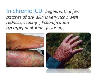 In chronic ICD: begins with a few
patches of dry skin is very itchy, with
redness, scaling , lichenification
hyperpigmentation ,fissuring.,
 
