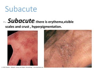 Subacute
• - Subacute: there is erythema,visible
scales and crust , hyperpigmentation.
 