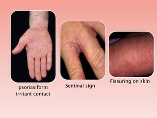 Sentinel Signs Rash Irritant contact dermatitis by dr maria saeed | PPTX