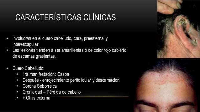 Las revocaciones sobre el tratamiento atopicheskogo de la dermatitis a los niños
