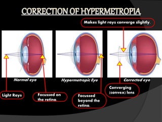 Normal eye Hypermetropic Eye
Light Rays Focussed on
the retina.
Focussed
beyond the
retina.
Converging
(convex) lens
Corrected eye
Makes light rays converge slightly.
 