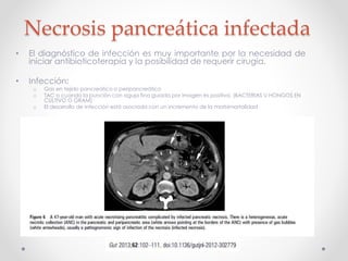 Pancreatitis aguda - Clasificación Atlanta