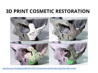 3D PRINT COSMETIC RESTORATION
abcnews.go.com/blogs/health/2014/03/13/mans-face-rebuilt-with-3d-printer-after-crash/
 