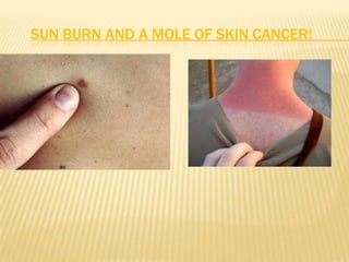 SUN BURN AND A MOLE OF SKIN CANCER!
 
