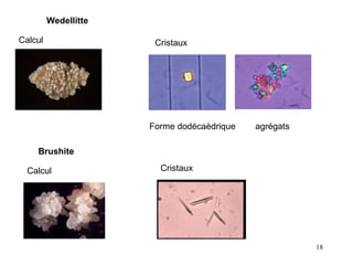 Wedellitte   Calcul  Cristaux  Forme dodécaèdrique agrégats  Brushite Calcul  Cristaux 