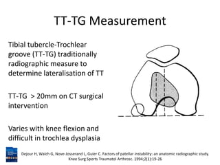 TT-TG Measurement
Tibial tubercle-Trochlear
groove (TT-TG) traditionally
radiographic measure to
determine lateralisation of TT
TT-TG > 20mm on CT surgical
intervention
Varies with knee flexion and
difficult in trochlea dysplasia
Dejour H, Walch G, Nove-Josserand L, Guier C. Factors of patellar instability: an anatomic radiographic study.
Knee Surg Sports Traumatol Arthrosc. 1994;2(1):19-26
 