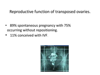 Reproductive function of transposed ovaries.
• 89% spontaneous pregnancy with 75%
occurring without repositioning.
• 11% conceived with IVF.
 