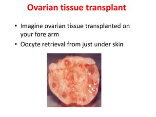 Ovarian tissue transplant
• Imagine ovarian tissue transplanted on
your fore arm
• Oocyte retrieval from just under skin
 