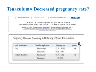 Tenaculum= Decreased pregnancy rate?
 