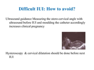 Difficult IUI: How to avoid?
Ultrasound guidance Measuring the utero-cervical angle with
ultrasound before IUI and moulding the catheter accordingly
increases clinical pregnancy
Hysteroscopy & cervical dilatation should be done before next
IUI
 