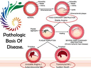 Ischemic heart disease, IHD, ihd, ischemic heart disease ischaemic ...
