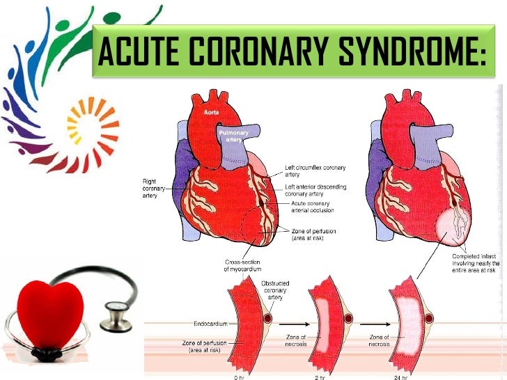 echo 2d test heart disease, Ischemic disease ischemic IHD, heart ihd, heart echo 2d test heart disease, Ischemic disease ischemic IHD, heart ihd, heart