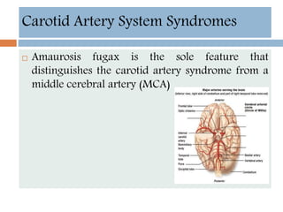  Amaurosis fugax is the sole feature that
distinguishes the carotid artery syndrome from a
middle cerebral artery (MCA)
Carotid Artery System Syndromes
 