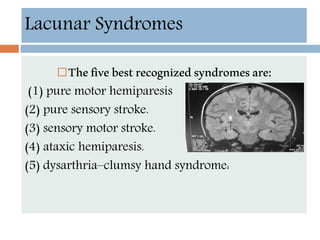 Lacunar Syndromes
Thefivebestrecognizedsyndromesare:
(1) pure motor hemiparesis
(2) pure sensory stroke.
(3) sensory motor stroke.
(4) ataxic hemiparesis.
(5) dysarthria–clumsy hand syndrome:
 