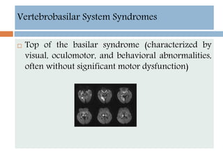  Top of the basilar syndrome (characterized by
visual, oculomotor, and behavioral abnormalities,
often without significant motor dysfunction)
Vertebrobasilar System Syndromes
 