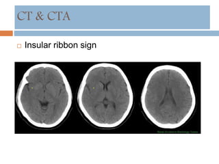  Insular ribbon sign
CT & CTA
 