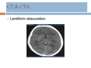 Lentiform obscuration
CT & CTA
 