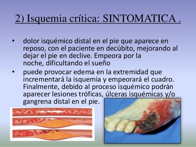 La ayuda a la trombosis de las extremidades inferiores