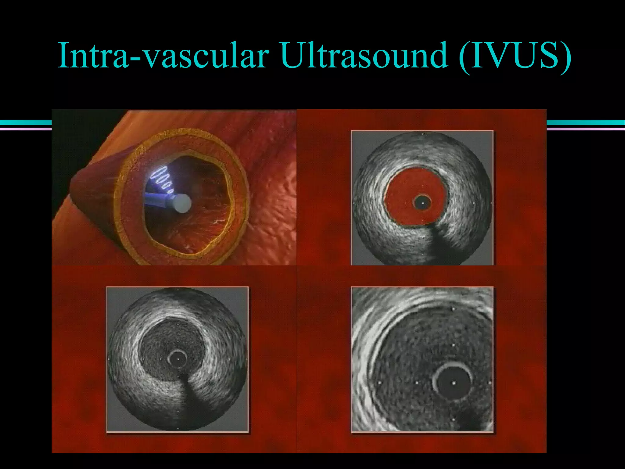 Intra-vascular Ultrasound (IVUS)
 