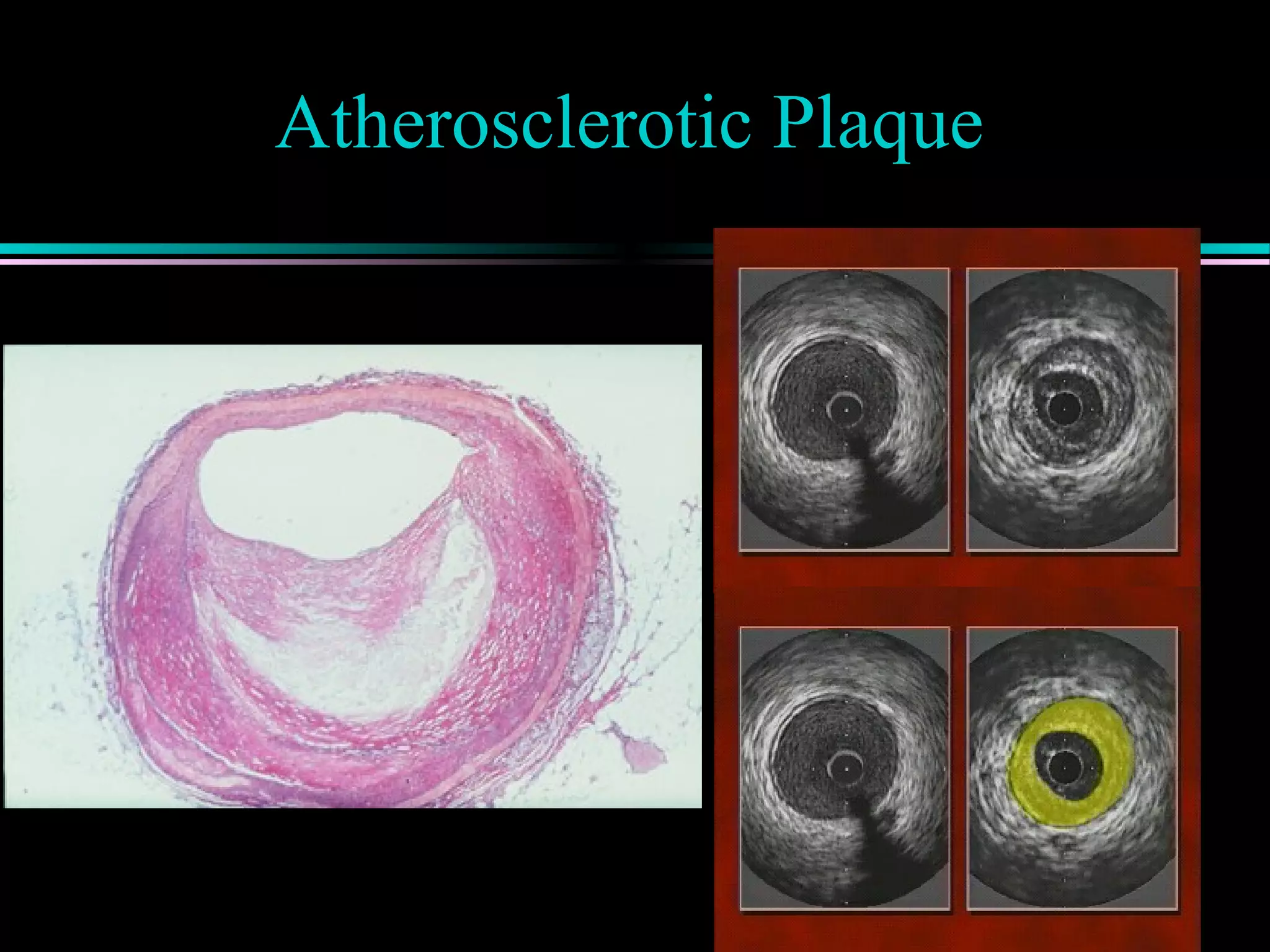 Atherosclerotic Plaque
 