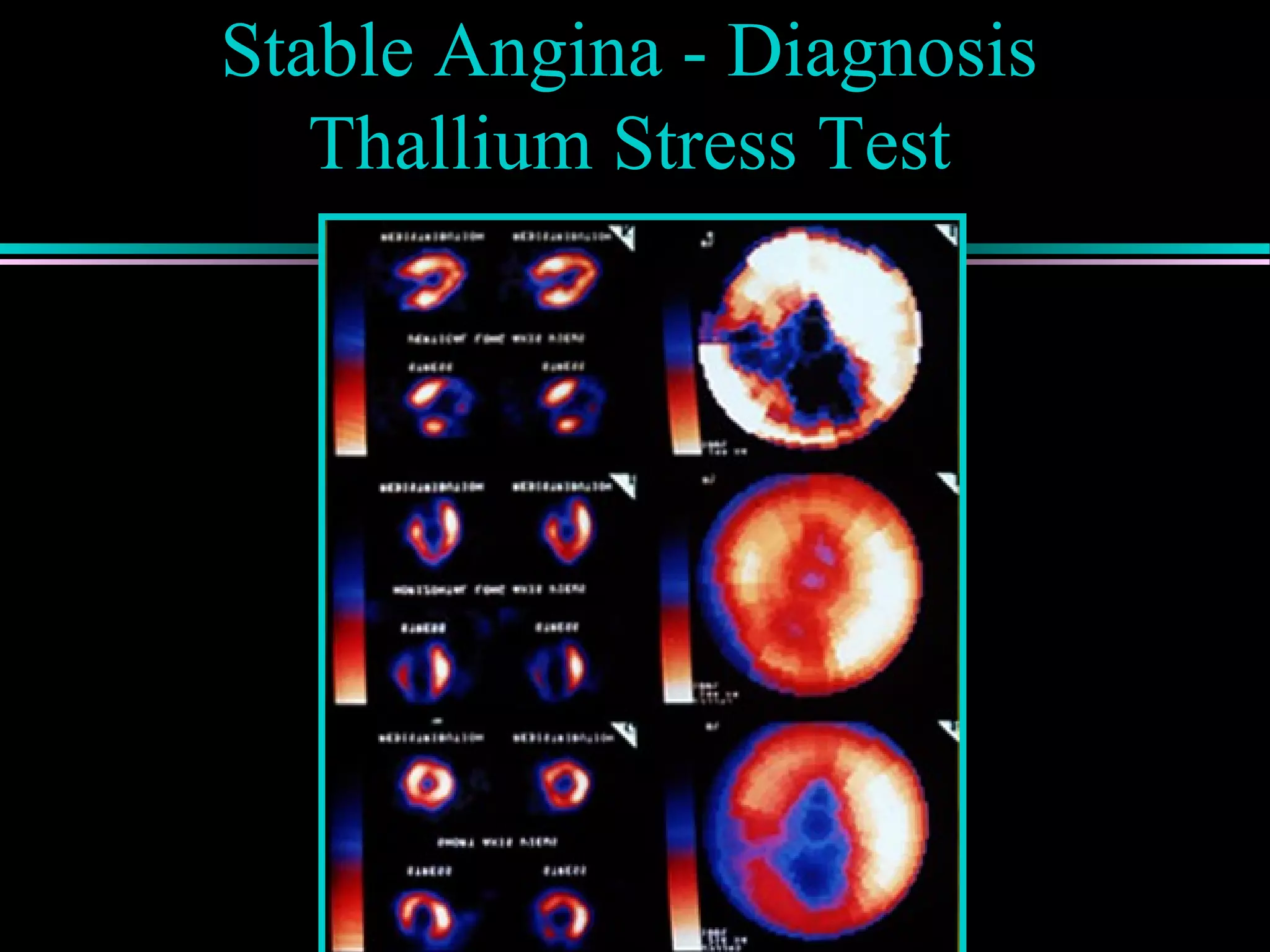 Stable Angina - Diagnosis
Thallium Stress Test
 