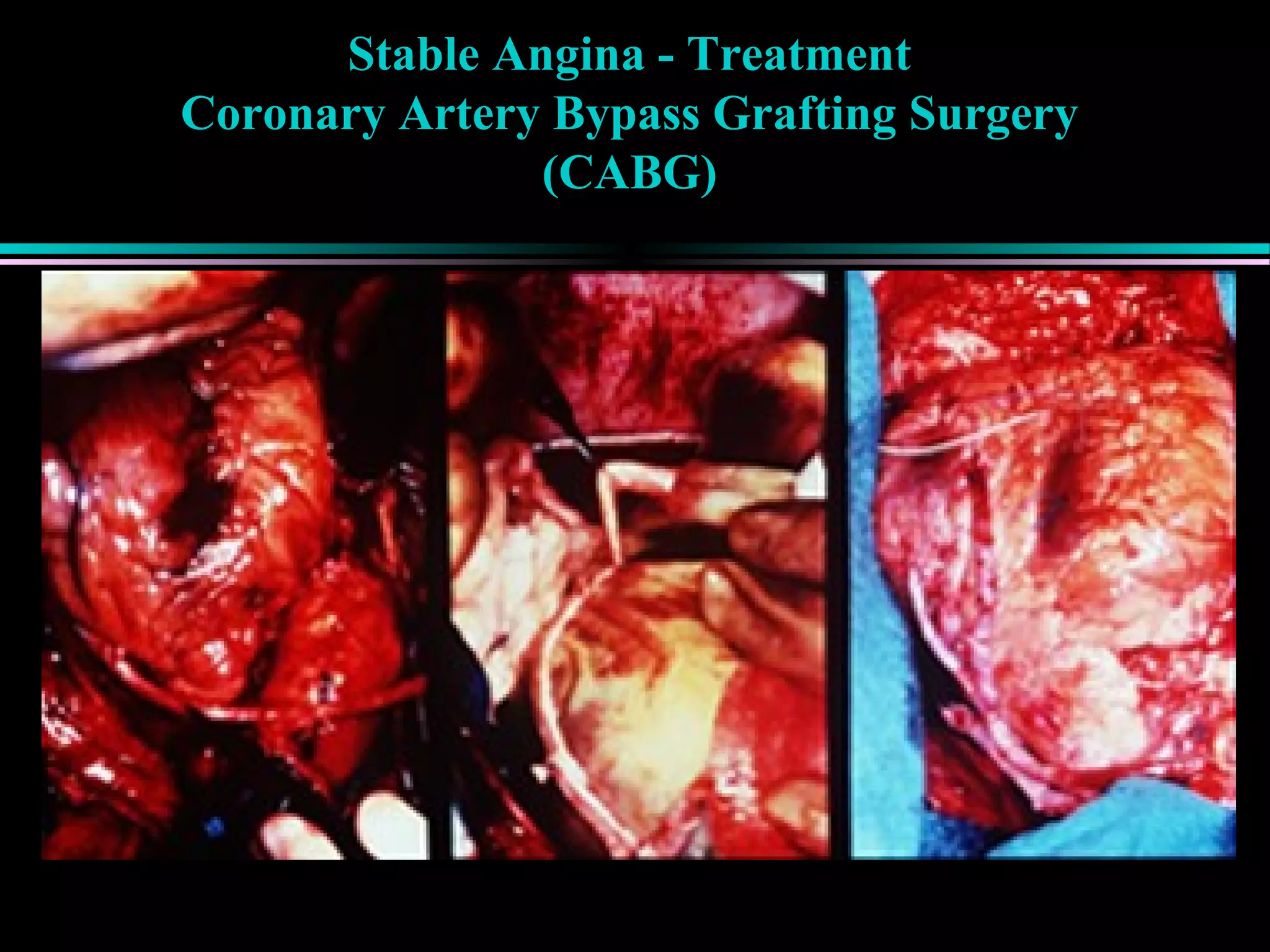 Stable Angina - Treatment
Coronary Artery Bypass Grafting Surgery
(CABG)
 