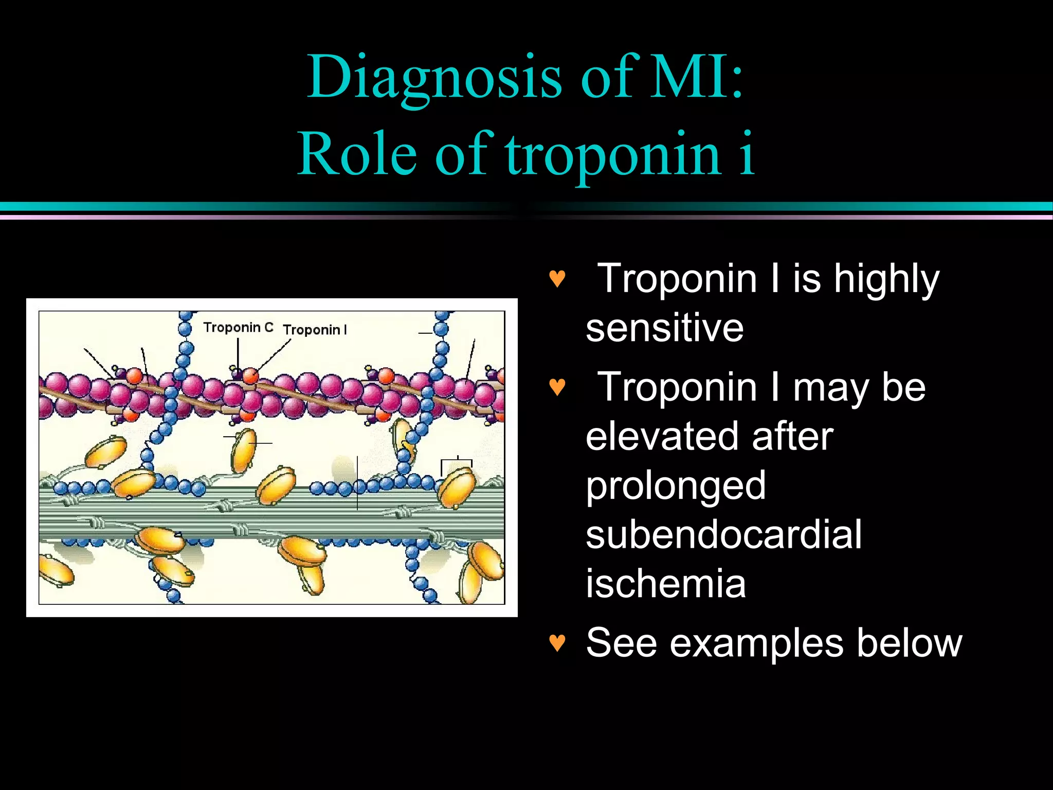 Diagnosis of MI:
Role of troponin i
♥ Troponin I is highly
sensitive
♥ Troponin I may be
elevated after
prolonged
subendocardial
ischemia
♥ See examples below
 