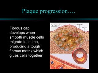 Plaque progression….
Fibrous cap
develops when
smooth muscle cells
migrate to intima,
producing a tough
fibrous matrix which
glues cells together
 