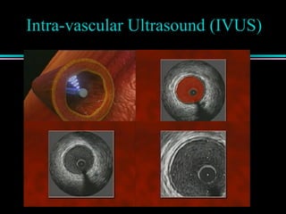 Intra-vascular Ultrasound (IVUS)
 